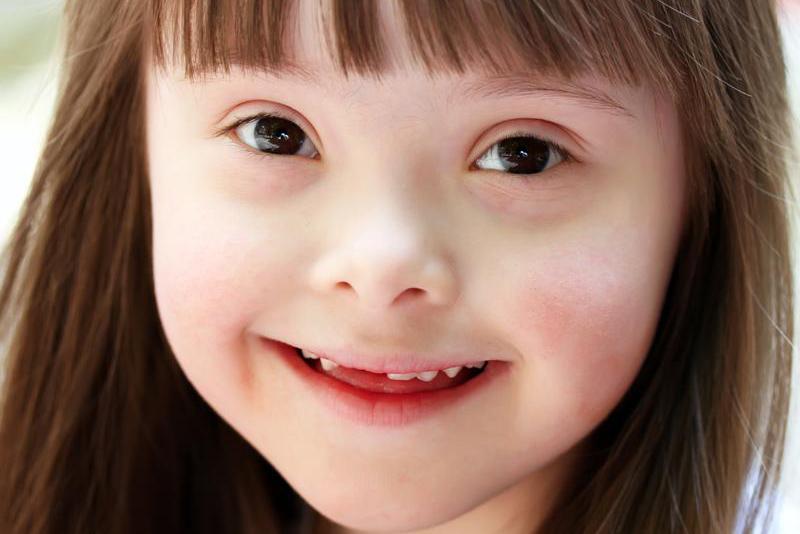 Down: trisomía angelical